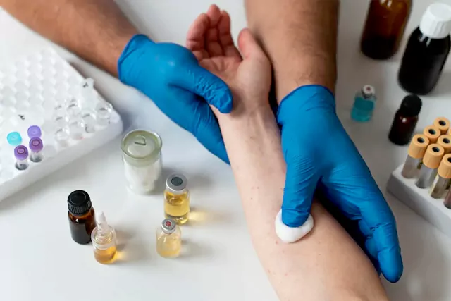 blood testing for Eczema treatment